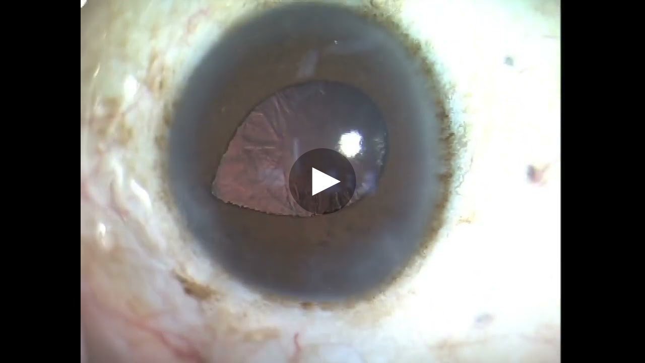 Thumbnail of Intraoperative Miosis video