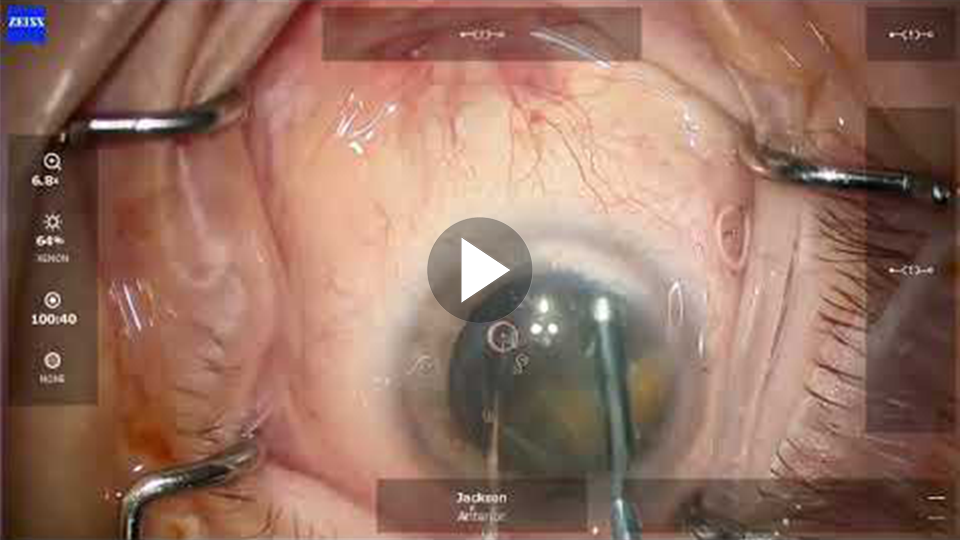 Thumbnail of Preoperative Poor Dilation video