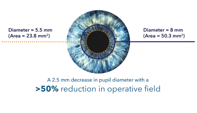 A pupil diameter reduction from 8 mm to 5.5 mm is over a 50% reduction in operative field