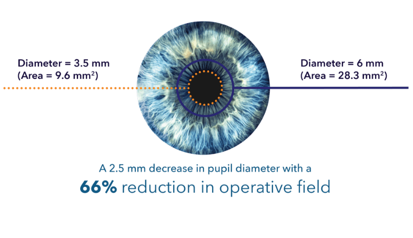 A pupil diameter reduction from 6 mm to 3.5 mm is over a 66% reduction in operative field